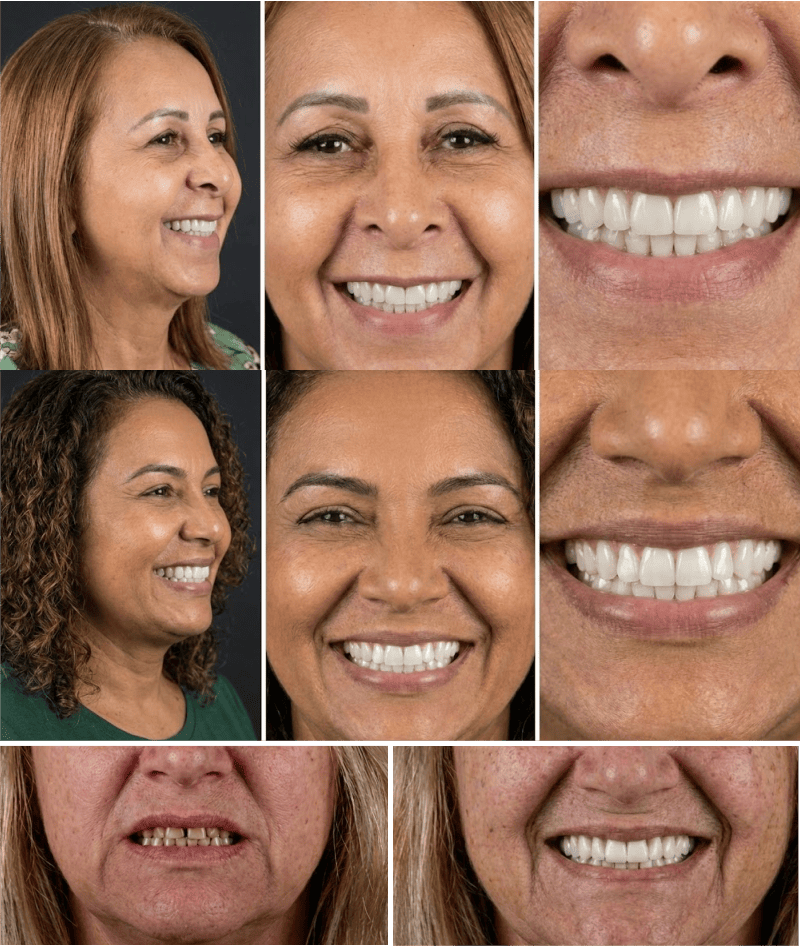 implantes dentário centro rio de janeiro